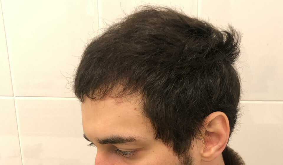фото мужчины после пересадки волос