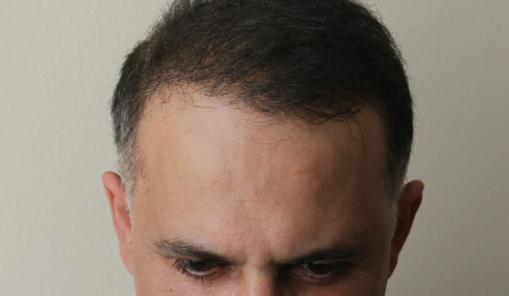 фото пациента пересадки волос