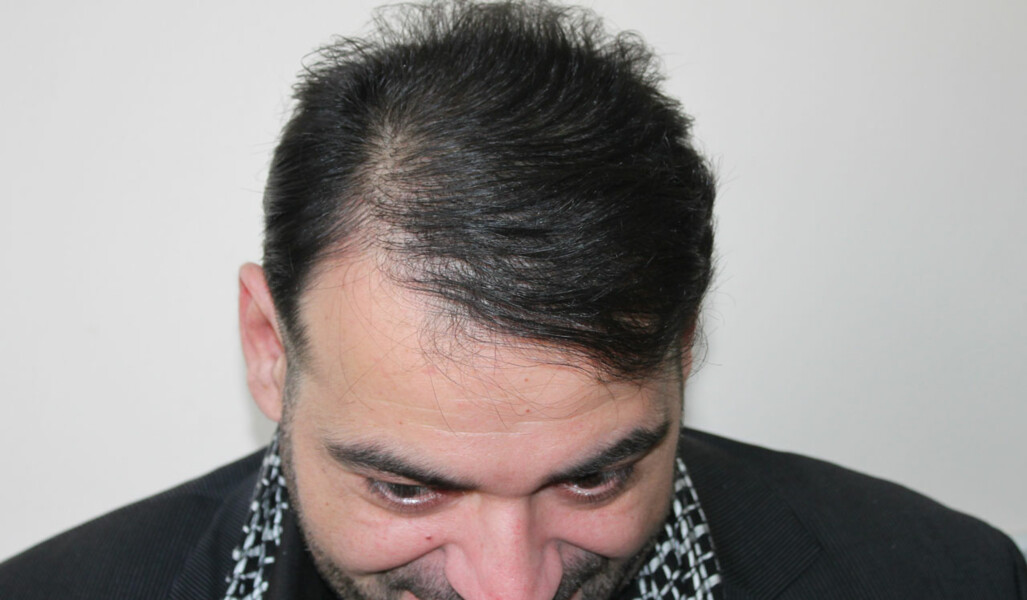 результат пересадки волос мужчине