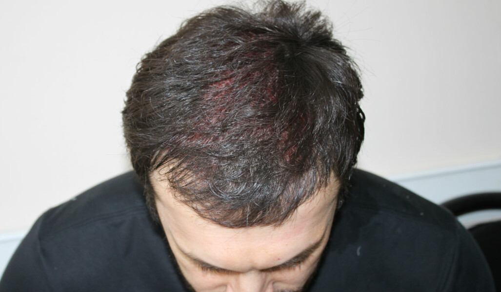голова мужчины после пересадки волос