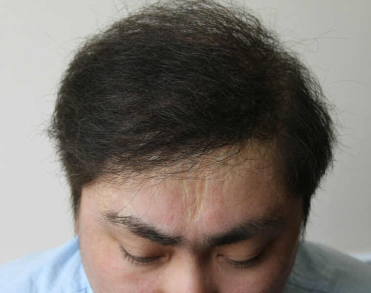эффект после пересадки волос мужчине