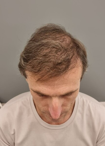 результат пересадки волос - киника Цилосани